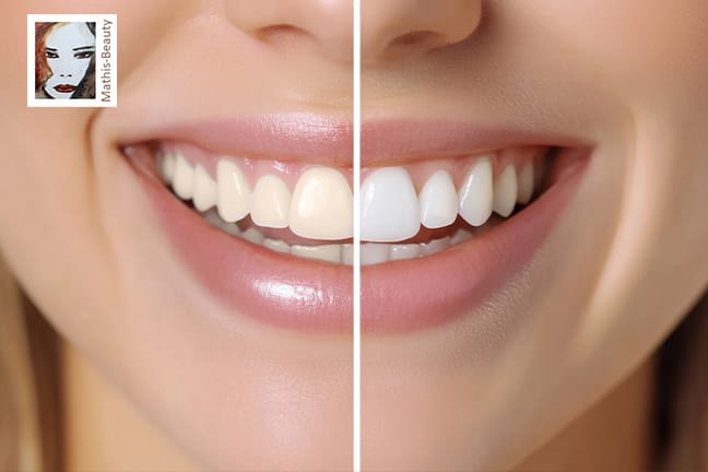 Zahnaufhellung mit LED oder Power Bleaching