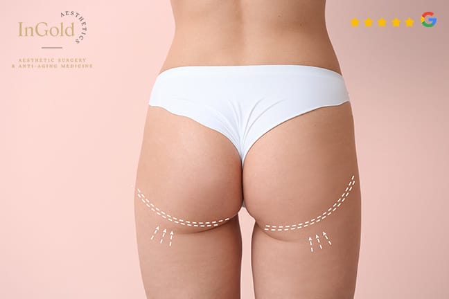 Po-Vergrösserung und/oder Lifting mit Sculptra®