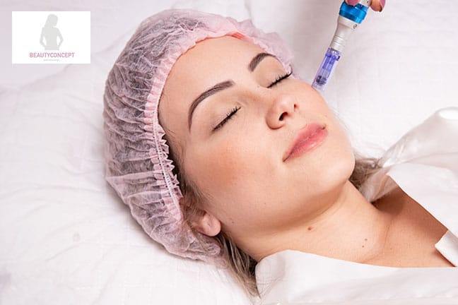 Medical Microneedling – Kollagenbooster für die Haut