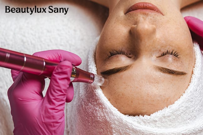 Microneedling