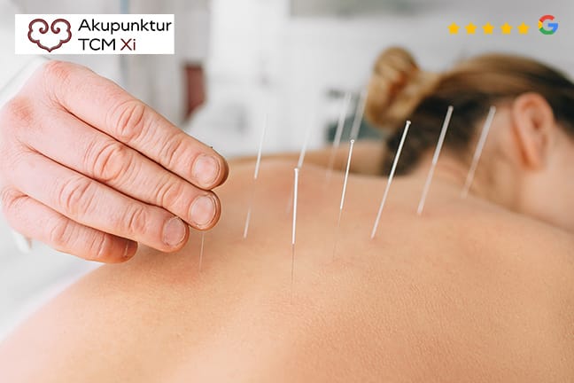 Akupunktur, Massage und Schröpfen nach TCM