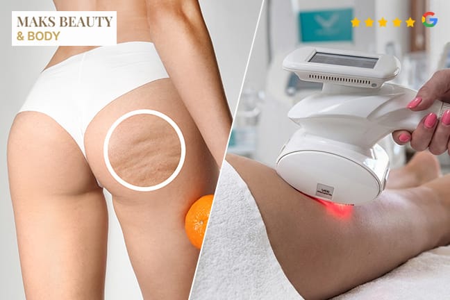 Anti-Cellulite-Kombi mit Lymphmassage und VelaShape