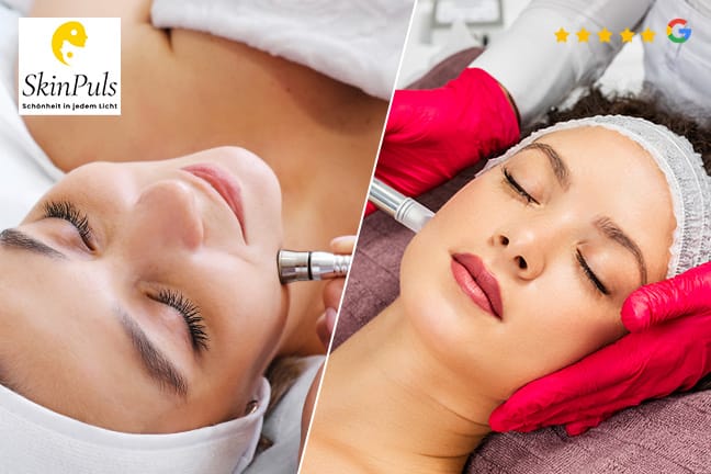 Microneedling – optional mit Microdermabrasion