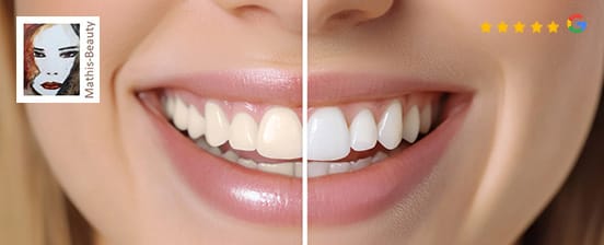Zahnaufhellung mit LED oder Power Bleaching