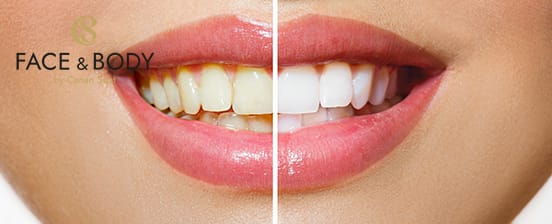 Kosmetisches Zahnbleaching mit LED-Licht