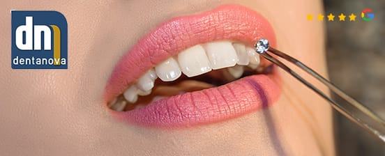 Zahnschmuck in der Zahnarztpraxis – inkl. Swarovski-Stein